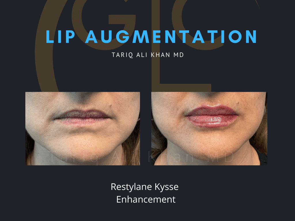 Gentle Care Laser Tustin Before and After picture - Lip Augmentation